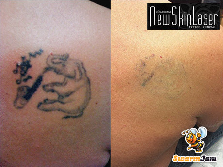 Montreal's Deal - 56% Off a $225 Tattoo Removal Session from New Skin ...